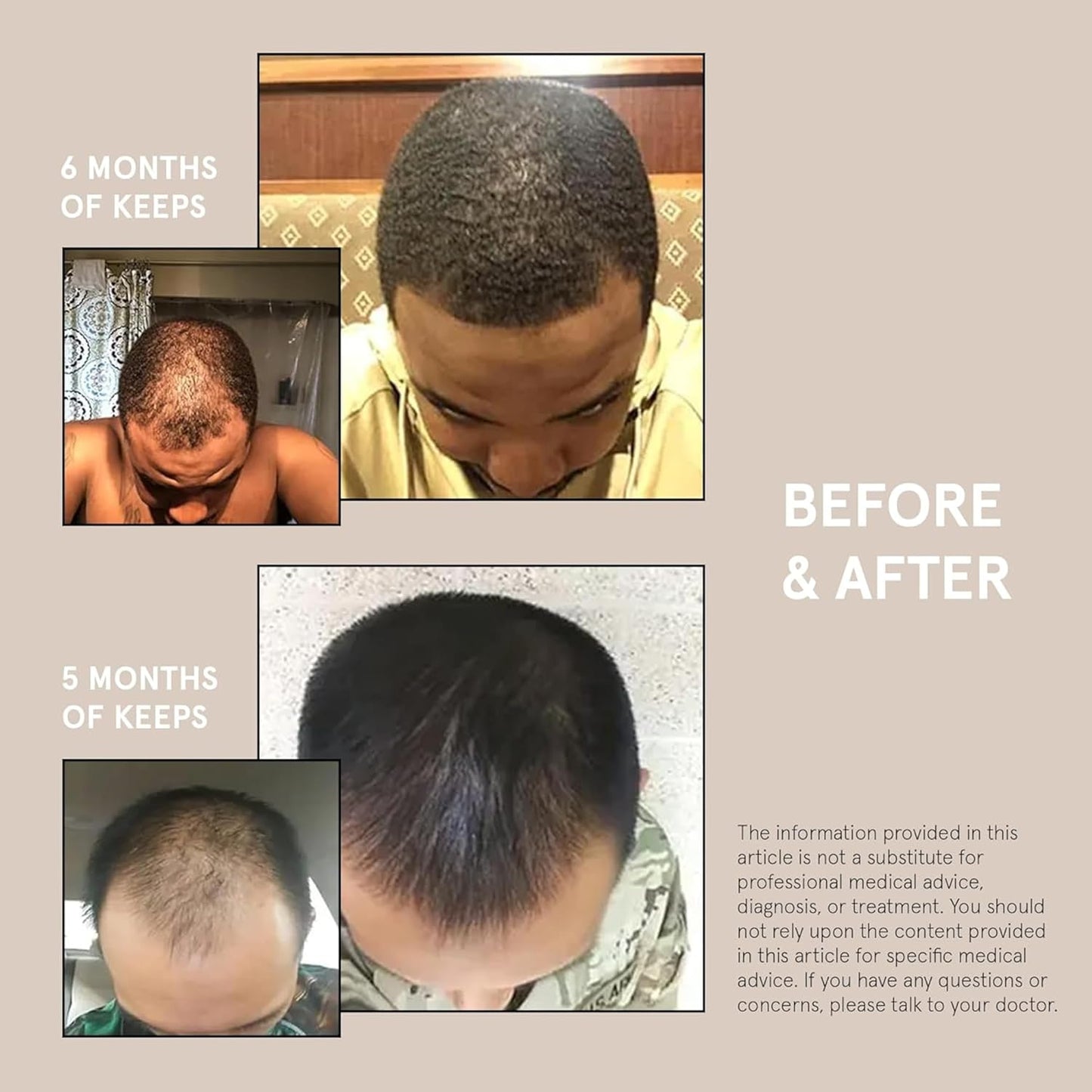 Keeps Extra Strength Minoxidil for Men Topical Hair Growth Serum, 5% Solution Hair Loss Treatment - 3 Month Supply (3 x 2oz Bottles with Dropper) - Slows Hair Loss & Promotes Thicker Hair Regrowth